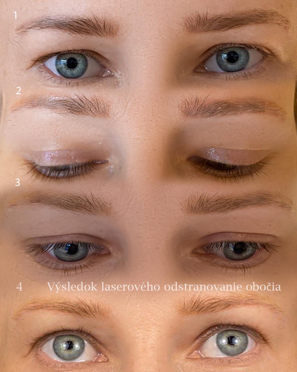 Laserové odstraňovanie 4
